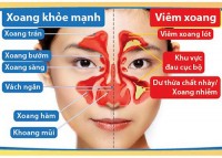 VIÊM XOANG